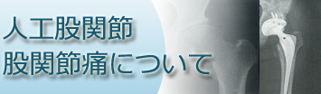 人工股関節について